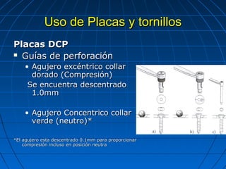 UUssoo ddee PPllaaccaass yy ttoorrnniillllooss 
PPllaaccaass DDCCPP 
 GGuuííaass ddee ppeerrffoorraacciióónn 
• AAgguujjeerroo eexxccéénnttrriiccoo ccoollllaarr 
ddoorraaddoo ((CCoommpprreessiióónn)) 
SSee eennccuueennttrraa ddeesscceennttrraaddoo 
11..00mmmm 
• AAgguujjeerroo CCoonncceennttrriiccoo ccoollllaarr 
vveerrddee ((nneeuuttrroo))** 
**EEll aagguujjeerroo eessttaa ddeesscceennttrraaddoo 00..11mmmm ppaarraa pprrooppoorrcciioonnaarr 
ccoommpprreessiióónn iinncclluussoo eenn ppoossiicciióónn nneeuuttrraa 
 