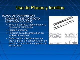 UUssoo ddee PPllaaccaass yy ttoorrnniillllooss 
PPLLAACCAA DDEE CCOOMMPPRREESSIIOONN 
DDIINNAAMMIICCAA DDEE CCOONNTTAACCTTOO 
LLIIMMIITTAADDOO ((LLCC-DDCCPP)) 
• ZZoonnaa ddee ccoonnttaaccttoo ppllaaccaa––hhuueessoo ssee 
eennccuueennttrraa ddiissmmiinnuuiiddaa 
• RRiiggiiddeezz uunniiffoorrmmee 
• PPrriinncciippiioo ddee aauuttooccoommpprreessiióónn eenn 
aammbbaass ddiirreecccciioonneess 
• DDeeffoorrmmaacciióónn eelláássttiiccaa ssuuaavvee eenn 
ttooddaa llaa ppllaaccaa ssiinn ccoonncceennttrraacciióónn ddee 
tteennssiióónn eenn uunnoo ddee llooss aagguujjeerrooss ddee 
llooss ttoorrnniillllooss 
 