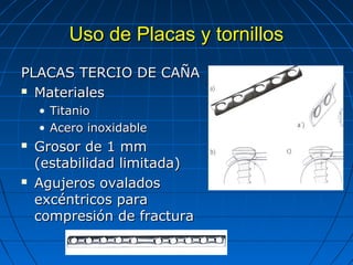 UUssoo ddee PPllaaccaass yy ttoorrnniillllooss 
PPLLAACCAASS TTEERRCCIIOO DDEE CCAAÑÑAA 
 MMaatteerriiaalleess 
• TTiittaanniioo 
• AAcceerroo iinnooxxiiddaabbllee 
 GGrroossoorr ddee 11 mmmm 
((eessttaabbiilliiddaadd lliimmiittaaddaa)) 
 AAgguujjeerrooss oovvaallaaddooss 
eexxccéénnttrriiccooss ppaarraa 
ccoommpprreessiióónn ddee ffrraaccttuurraa 
 