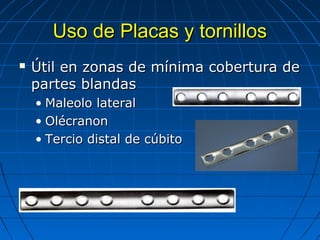 UUssoo ddee PPllaaccaass yy ttoorrnniillllooss 
 ÚÚttiill eenn zzoonnaass ddee mmíínniimmaa ccoobbeerrttuurraa ddee 
ppaarrtteess bbllaannddaass 
• MMaalleeoolloo llaatteerraall 
• OOllééccrraannoonn 
• TTeerrcciioo ddiissttaall ddee ccúúbbiittoo 
 