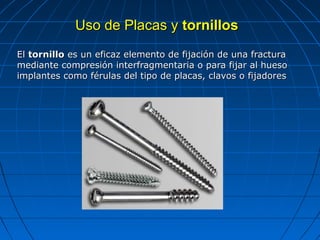 UUssoo ddee PPllaaccaass yy ttoorrnniillllooss 
EEll ttoorrnniilllloo eess uunn eeffiiccaazz eelleemmeennttoo ddee ffiijjaacciióónn ddee uunnaa ffrraaccttuurraa 
mmeeddiiaannttee ccoommpprreessiióónn iinntteerrffrraaggmmeennttaarriiaa oo ppaarraa ffiijjaarr aall hhuueessoo 
iimmppllaanntteess ccoommoo fféérruullaass ddeell ttiippoo ddee ppllaaccaass,, ccllaavvooss oo ffiijjaaddoorreess 
 