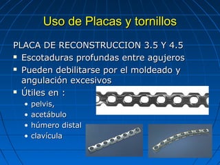 UUssoo ddee PPllaaccaass yy ttoorrnniillllooss 
PPLLAACCAA DDEE RREECCOONNSSTTRRUUCCCCIIOONN 33..5 YY 44..5 
 EEssccoottaadduurraass pprrooffuunnddaass eennttrree aagguujjeerrooss 
 PPuueeddeenn ddeebbiilliittaarrssee ppoorr eell mmoollddeeaaddoo yy 
aanngguullaacciióónn eexxcceessiivvooss 
 ÚÚttiilleess eenn :: 
• ppeellvviiss,, 
• aacceettáábbuulloo 
• hhúúmmeerroo ddiissttaall 
• ccllaavvííccuullaa 
 