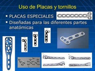 UUssoo ddee PPllaaccaass yy ttoorrnniillllooss 
 PPLLAACCAASS EESSPPEECCIIAALLEESS 
 DDiisseeññaaddaass ppaarraa llaass ddiiffeerreenntteess ppaarrtteess 
aannaattóómmiiccaass 
 