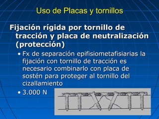 UUssoo ddee PPllaaccaass yy ttoorrnniillllooss 
FFiijjaacciióónn rrííggiiddaa ppoorr ttoorrnniilllloo ddee 
ttrraacccciióónn yy ppllaaccaa ddee nneeuuttrraalliizzaacciióónn 
((pprrootteecccciióónn)) 
• FFxx ddee sseeppaarraacciióónn eeppiiffiissiioommeettaaffiissiiaarriiaass llaa 
ffiijjaacciióónn ccoonn ttoorrnniilllloo ddee ttrraacccciióónn eess 
nneecceessaarriioo ccoommbbiinnaarrlloo ccoonn ppllaaccaa ddee 
ssoossttéénn ppaarraa pprrootteeggeerr aall ttoorrnniilllloo ddeell 
cciizzaallllaammiieennttoo 
• 33..000000 NN 
 