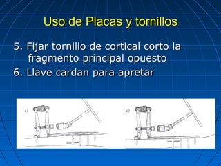 UUssoo ddee PPllaaccaass yy ttoorrnniillllooss 
55.. FFiijjaarr ttoorrnniilllloo ddee ccoorrttiiccaall ccoorrttoo llaa 
ffrraaggmmeennttoo pprriinncciippaall ooppuueessttoo 
66.. LLllaavvee ccaarrddaann ppaarraa aapprreettaarr 
 