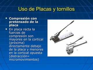 UUssoo ddee PPllaaccaass yy ttoorrnniillllooss 
 CCoommpprreessiióónn ccoonn 
pprreetteennssaaddoo ddee llaa 
ppllaaccaa 
 EEnn ppllaaccaa rreeccttaa llaa 
ffuueerrzzaass ddee 
ccoommpprreessiióónn ssoonn 
mmaayyoorreess eenn llaa ccoorrttiiccaall 
((pprróóxxiimmaa)) 
ddiirreeccttaammeennttee ddeebbaajjoo 
ddee llaa ppllaaccaa yy mmeennoorreess 
eenn llaa ccoorrttiiccaall ooppuueessttaa 
((ddiissttrraacccciióónn== 
mmiiccrroommoovviimmiieennttooss)) 
 