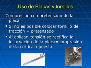 UUssoo ddee PPllaaccaass yy ttoorrnniillllooss 
CCoommpprreessiióónn ccoonn pprreetteennssaaddoo ddee llaa 
ppllaaccaa 
 SSii nnoo eess ppoossiibbllee ccoollooccaarr ttoorrnniilllloo ddee 
ttrraacccciióónn == pprreetteennssaaddoo 
 AAll aapplliiccaarr tteennssiióónn ssee rreeccttiiffiiccaa llaa 
iinnccuurrvvaacciióónn ddee llaa ppllaaccaa==ccoommpprreessiióónn 
ddee llaa ccoorrttiiccaall ooppuueessttaa 
 