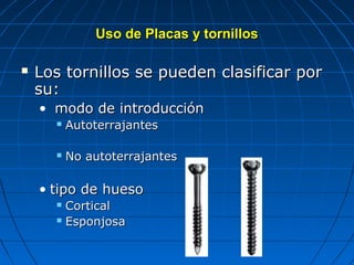 UUssoo ddee PPllaaccaass yy ttoorrnniillllooss 
 LLooss ttoorrnniillllooss ssee ppuueeddeenn ccllaassiiffiiccaarr ppoorr 
ssuu:: 
• mmooddoo ddee iinnttrroodduucccciióónn 
 AAuuttootteerrrraajjaanntteess 
 NNoo aauuttootteerrrraajjaanntteess 
• ttiippoo ddee hhuueessoo 
 CCoorrttiiccaall 
 EEssppoonnjjoossaa 
 