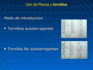 UUssoo ddee PPllaaccaass yy ttoorrnniillllooss 
MMooddoo ddee iinnttrroodduucccciioonn 
 TToorrnniillllllooss aauuttootteerrrraajjaanntteess 
 TToorrnniillllooss NNoo aauuttootteerrrraajjaanntteess 
 