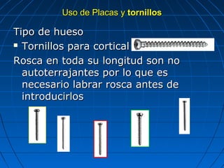 UUssoo ddee PPllaaccaass yy ttoorrnniillllooss 
TTiippoo ddee hhuueessoo 
 TToorrnniillllooss ppaarraa ccoorrttiiccaall 
RRoossccaa eenn ttooddaa ssuu lloonnggiittuudd ssoonn nnoo 
aauuttootteerrrraajjaanntteess ppoorr lloo qquuee eess 
nneecceessaarriioo llaabbrraarr rroossccaa aanntteess ddee 
iinnttrroodduucciirrllooss 
 
