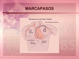 MARCAPASOS 
