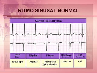 RITMO SINUSAL NORMAL 
