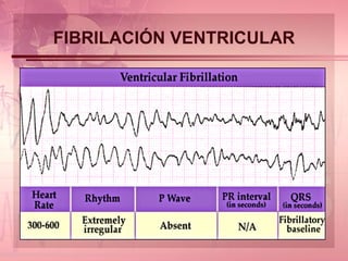 FIBRILACIÓN VENTRICULAR 