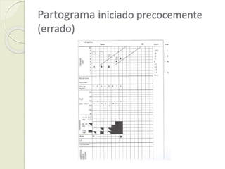 Partograma iniciado precocemente
(errado)
 