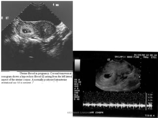 Ultrasonography of pelvic mass in early pregnancy | PDF