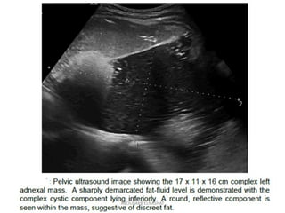 Ultrasonography of pelvic mass in early pregnancy | PDF