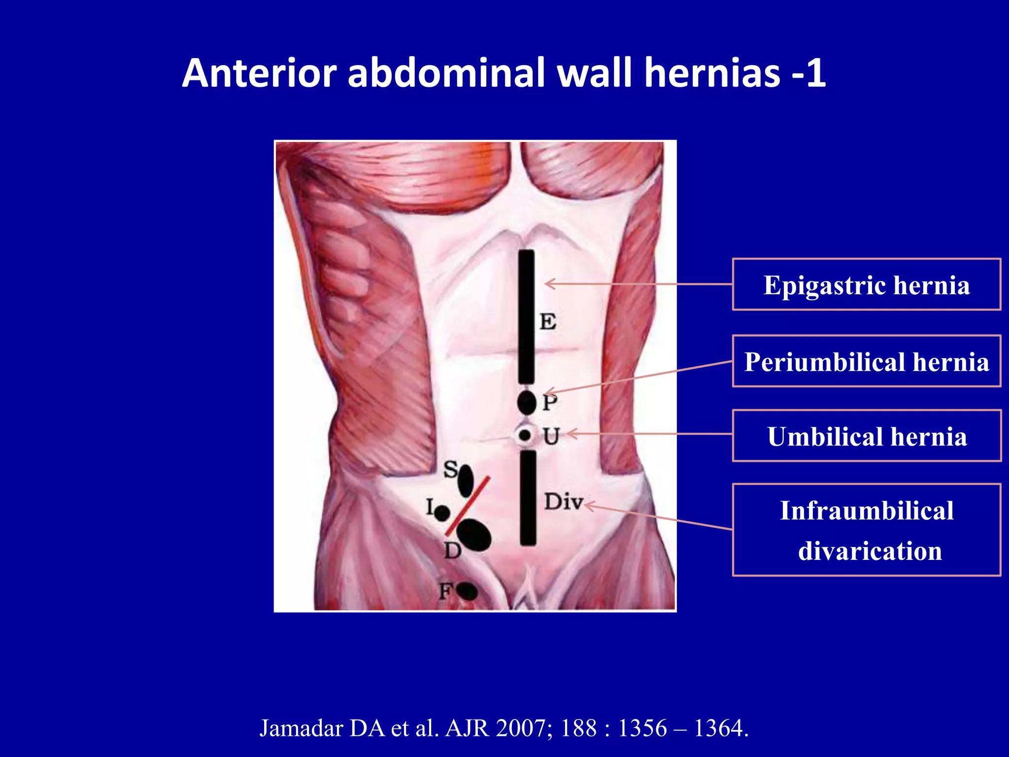 Ultrasound of the abdominal wall hernias | PPTX