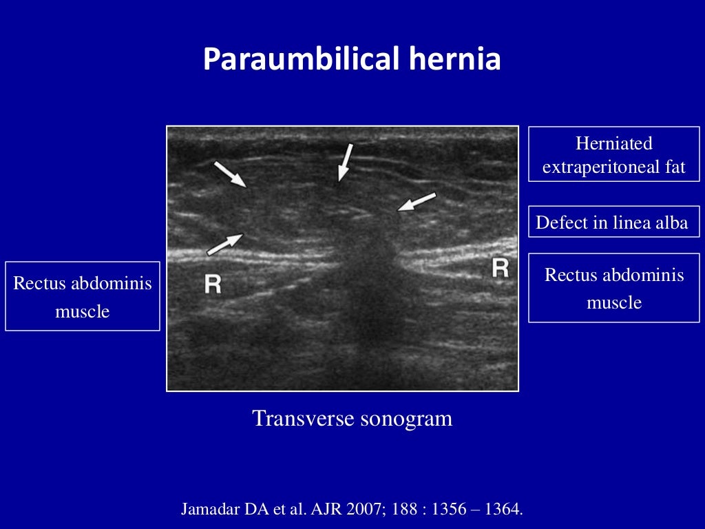 Abdominal Hernia Ultrasound