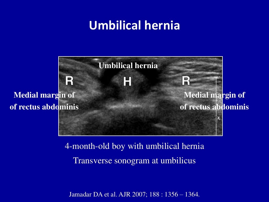 Abdominal Hernia Ultrasound