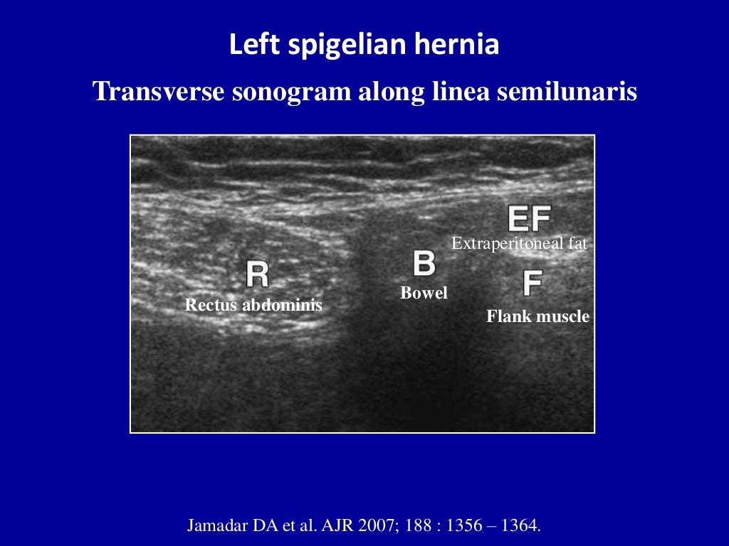 Ultrasound of the abdominal wall hernias