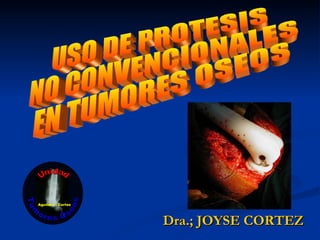 Dra.; JOYSE CORTEZ USO DE PROTESIS  NO CONVENCIONALES  EN TUMORES OSEOS Unidad Tumores Oseos Aguilera - Cortez 