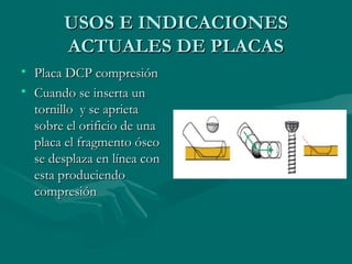 UUSSOOSS EE IINNDDIICCAACCIIOONNEESS 
AACCTTUUAALLEESS DDEE PPLLAACCAASS 
• PPllaaccaa DDCCPP ccoommpprreessiióónn 
• CCuuaannddoo ssee iinnsseerrttaa uunn 
ttoorrnniilllloo yy ssee aapprriieettaa 
ssoobbrree eell oorriiffiicciioo ddee uunnaa 
ppllaaccaa eell ffrraaggmmeennttoo óósseeoo 
ssee ddeessppllaazzaa eenn llíínneeaa ccoonn 
eessttaa pprroodduucciieennddoo 
ccoommpprreessiióónn 
 