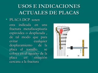 UUSSOOSS EE IINNDDIICCAACCIIOONNEESS 
AACCTTUUAALLEESS DDEE PPLLAACCAASS 
• PPLLAACCAA DDCCPP ssootteenn 
eessttaa iinnddiiccaaddaa eenn uunnaa 
ffrraaccttuurraa mmeettaaffiissooeeppiissaarriiaa 
eessppiirrooiiddeeaa oo ddeessppllaazzaaddaa ,, 
ddee ttaall mmooddoo qquuee ppaarraa 
eevviittaarr ccuuaallqquuiieerr 
ddeessppllaazzaammiieennttoo ddee llaa 
ppllaaccaa eell ttoorrnniilllloo ssee 
ccoollooccaa eenn eell aagguujjeerroo ddee llaa 
ppllaaccaa eenn ssiittuuaacciióónn 
cceerrccaannaa aa llaa ffrraaccttuurraa 
 