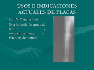 UUSSOOSS EE IINNDDIICCAACCIIOONNEESS 
AACCTTUUAALLEESS DDEE PPLLAACCAASS 
• LLaa DDCCPP aanncchhaa 44..55mmmm 
EEssttaa iinnddiiccaaddaa ffrraaccttuurraass ddee 
fféémmuurr yy 
eexxcceeppcciioonnaallmmeennttee eenn 
ffrraaccttuurraass ddee hhuummeerroo 
 
