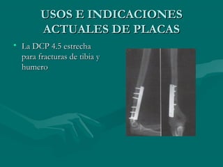 UUSSOOSS EE IINNDDIICCAACCIIOONNEESS 
AACCTTUUAALLEESS DDEE PPLLAACCAASS 
• LLaa DDCCPP 44..55 eessttrreecchhaa 
ppaarraa ffrraaccttuurraass ddee ttiibbiiaa yy 
hhuummeerroo 
 