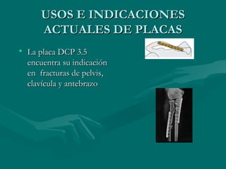 UUSSOOSS EE IINNDDIICCAACCIIOONNEESS 
AACCTTUUAALLEESS DDEE PPLLAACCAASS 
• LLaa ppllaaccaa DDCCPP 33..55 
eennccuueennttrraa ssuu iinnddiiccaacciióónn 
eenn ffrraaccttuurraass ddee ppeellvviiss,, 
ccllaavvííccuullaa yy aanntteebbrraazzoo 
 