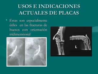 UUSSOOSS EE IINNDDIICCAACCIIOONNEESS 
AACCTTUUAALLEESS DDEE PPLLAACCAASS 
• EEssttaass ssoonn eessppeecciiaallmmeennttee 
úúttiilleess eenn llaass ffrraaccttuurraass ddee 
hhuueessooss ccoonn oorriieennttaacciióónn 
ttrriiddiimmeennssiioonnaall 
 