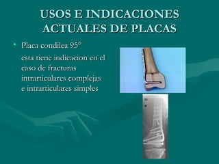 UUSSOOSS EE IINNDDIICCAACCIIOONNEESS 
AACCTTUUAALLEESS DDEE PPLLAACCAASS 
• PPllaaccaa ccoonnddiilleeaa 9955°° 
eessttaa ttiieennee iinnddiiccaacciioonn eenn eell 
ccaassoo ddee ffrraaccttuurraass 
iinnttrraarrttiiccuullaarreess ccoommpplleejjaass 
ee iinnttrraarrttiiccuullaarreess ssiimmpplleess 
 