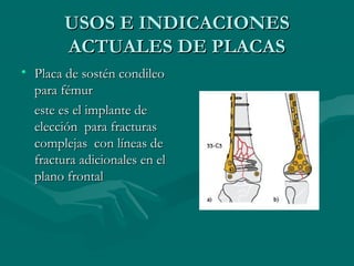 UUSSOOSS EE IINNDDIICCAACCIIOONNEESS 
AACCTTUUAALLEESS DDEE PPLLAACCAASS 
• PPllaaccaa ddee ssoossttéénn ccoonnddiilleeoo 
ppaarraa fféémmuurr 
eessttee eess eell iimmppllaannttee ddee 
eelleecccciióónn ppaarraa ffrraaccttuurraass 
ccoommpplleejjaass ccoonn llíínneeaass ddee 
ffrraaccttuurraa aaddiicciioonnaalleess eenn eell 
ppllaannoo ffrroonnttaall 
 