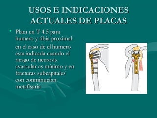 UUSSOOSS EE IINNDDIICCAACCIIOONNEESS 
AACCTTUUAALLEESS DDEE PPLLAACCAASS 
• PPllaaccaa eenn TT 44..55 ppaarraa 
hhuummeerroo yy ttiibbiiaa pprrooxxiimmaall 
eenn eell ccaassoo ddee eell hhuummeerroo 
eessttaa iinnddiiccaaddaa ccuuaannddoo eell 
rriieessggoo ddee nneeccrroossiiss 
aavvaassccuullaarr eess mmíínniimmoo yy eenn 
ffrraaccttuurraass ssuubbccaappiittaalleess 
ccoonn ccoonnmmiinnuucciioonn 
mmeettaaffiissaarriiaa 
 