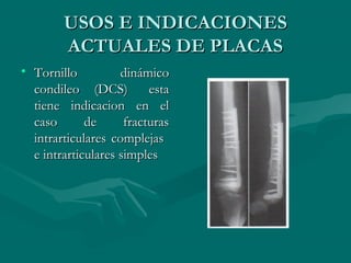 UUSSOOSS EE IINNDDIICCAACCIIOONNEESS 
AACCTTUUAALLEESS DDEE PPLLAACCAASS 
• TToorrnniilllloo ddiinnáámmiiccoo 
ccoonnddiilleeoo ((DDCCSS)) eessttaa 
ttiieennee iinnddiiccaacciioonn eenn eell 
ccaassoo ddee ffrraaccttuurraass 
iinnttrraarrttiiccuullaarreess ccoommpplleejjaass 
ee iinnttrraarrttiiccuullaarreess ssiimmpplleess 
 