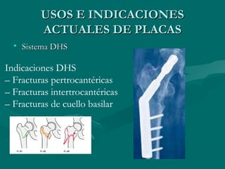 UUSSOOSS EE IINNDDIICCAACCIIOONNEESS 
AACCTTUUAALLEESS DDEE PPLLAACCAASS 
• SSiisstteemmaa DDHHSS 
Indicaciones DHS 
– Fracturas pertrocantéricas 
– Fracturas intertrocantéricas 
– Fracturas de cuello basilar 
 