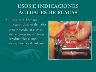 UUSSOOSS EE IINNDDIICCAACCIIOONNEESS 
AACCTTUUAALLEESS DDEE PPLLAACCAASS 
• PPllaaccaa eenn TT 33..55 ppaarraa 
ffrraaccttuurraass ddííssttaalleess ddee rraaddiioo 
eessttaa iinnddiiccaaddaa eenn eell ccaassoo 
ddee ffrraaccttuurraass iinneessttaabblleess oo 
iirrrreedduuccttiibblleess ccuuaannddoo 
eexxiissttee bbuueennaa ccaalliiddaadd óósseeaa 
 