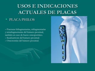 UUSSOOSS EE IINNDDIICCAACCIIOONNEESS 
AACCTTUUAALLEESS DDEE PPLLAACCAASS 
• PPLLAACCAA PPHHIILLOOSS 
– Fracturas bifragmentarias, trifragmentarias 
y tetrafragmentarias del húmero proximal, 
también en caso de hueso osteoporótico. 
– Seudoartrosis del húmero proximal. 
– Osteotomías del húmero proximal. 
 