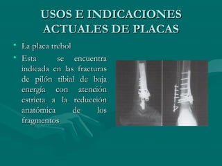 UUSSOOSS EE IINNDDIICCAACCIIOONNEESS 
AACCTTUUAALLEESS DDEE PPLLAACCAASS 
• LLaa ppllaaccaa ttrreebbooll 
• EEssttaa ssee eennccuueennttrraa 
iinnddiiccaaddaa eenn llaass ffrraaccttuurraass 
ddee ppiillóónn ttiibbiiaall ddee bbaajjaa 
eenneerrggííaa ccoonn aatteenncciióónn 
eessttrriiccttaa aa llaa rreedduucccciióónn 
aannaattóómmiiccaa ddee llooss 
ffrraaggmmeennttooss 
 