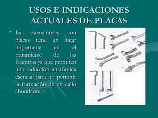 UUSSOOSS EE IINNDDIICCAACCIIOONNEESS 
AACCTTUUAALLEESS DDEE PPLLAACCAASS 
• LLaa oosstteeoossiinntteessiiss ccoonn 
ppllaaccaass ttiieennee uunn lluuggaarr 
iimmppoorrttaannttee eenn eell 
ttrraattaammiieennttoo ddee llaass 
ffrraaccttuurraass yyaa qquuee ppeerrmmiitteenn 
uunnaa rreedduucccciióónn aannaattóómmiiccaa 
eesseenncciiaall ppaarraa nnoo ppeerrmmiittiirr 
llaa ffoorrmmaacciióónn ddee uunn ccaalllloo 
aabbuunnddaannttee 
 