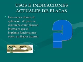 UUSSOOSS EE IINNDDIICCAACCIIOONNEESS 
AACCTTUUAALLEESS DDEE PPLLAACCAASS 
• EEssttaa nnuueevvaa ttééccnniiccaa ddee 
aapplliiccaacciióónn ddee ppllaaccaa ssee 
ddeennoommiinnaa ccoommoo ffiijjaacciióónn 
iinntteerrnnaa yyaa qquuee eell 
iimmppllaannttee ffuunncciioonnaa mmaass 
ccoommoo uunn ffiijjaaddoorr eexxtteerrnnoo 
 
