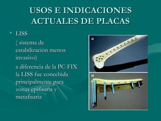 UUSSOOSS EE IINNDDIICCAACCIIOONNEESS 
AACCTTUUAALLEESS DDEE PPLLAACCAASS 
• LLIISSSS 
(( ssiisstteemmaa ddee 
eessttaabbiilliizzaacciióónn mmeennooss 
iinnvvaassiivvoo)) 
aa ddiiffeerreenncciiaa ddee llaa PPCC--FFIIXX 
llaa LLIISSSS ffuuee ccoonncceebbiiddaa 
pprriinncciippaallmmeennttee ppaarraa 
zzoonnaass eeppiiffiissaarriiaa yy 
mmeettaaffiissaarriiaa 
 