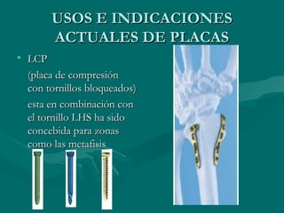 UUSSOOSS EE IINNDDIICCAACCIIOONNEESS 
AACCTTUUAALLEESS DDEE PPLLAACCAASS 
• LLCCPP 
((ppllaaccaa ddee ccoommpprreessiióónn 
ccoonn ttoorrnniillllooss bbllooqquueeaaddooss)) 
eessttaa eenn ccoommbbiinnaacciióónn ccoonn 
eell ttoorrnniilllloo LLHHSS hhaa ssiiddoo 
ccoonncceebbiiddaa ppaarraa zzoonnaass 
ccoommoo llaass mmeettaaffiissiiss 
 