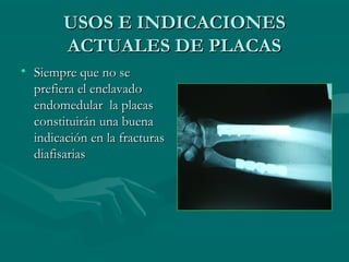 UUSSOOSS EE IINNDDIICCAACCIIOONNEESS 
AACCTTUUAALLEESS DDEE PPLLAACCAASS 
• SSiieemmpprree qquuee nnoo ssee 
pprreeffiieerraa eell eennccllaavvaaddoo 
eennddoommeedduullaarr llaa ppllaaccaass 
ccoonnssttiittuuiirráánn uunnaa bbuueennaa 
iinnddiiccaacciióónn eenn llaa ffrraaccttuurraass 
ddiiaaffiissaarriiaass 
 