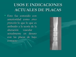 UUSSOOSS EE IINNDDIICCAACCIIOONNEESS 
AACCTTUUAALLEESS DDEE PPLLAACCAASS 
• EEssttoo ffuuee ccoonnoocciiddoo ccoonn 
aanntteerriioorriiddaadd ccoommoo ssttrreessss 
pprrootteecccciióónn lloo qquuee lloo qquuee eess 
aattrriibbuuiiddoo aa llaa tteeoorrííaa ddee llaa 
aalltteerraacciióónn vvaassccuullaarr 
aaccttuuaallmmeennttee eenn ddeessuussoo 
ccoonn llaass ppllaaccaass ddee bbaajjoo 
ccoonnttaaccttoo 
 