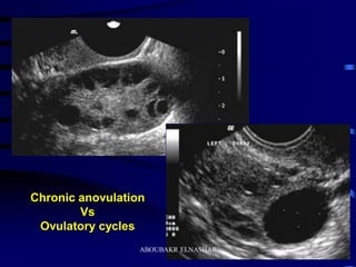 Ultrasonography of the ovary | PDF