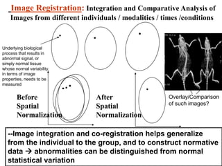 Image Registration: Integration and Comparative Analysis of
Images from different individuals / modalities / times /conditions
Before
Spatial
Normalization
After
Spatial
Normalization
--Image integration and co-registration helps generalize
from the individual to the group, and to construct normative
data  abnormalities can be distinguished from normal
statistical variation
Underlying biological
process that results in
abnormal signal, or
simply normal tissue
whose normal variability,
in terms of image
properties, needs to be
measured
Overlay/Comparison
of such images?
 