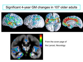 Significant 4-year GM changes in 107 older adults
From the cover page of
the Lancet, Neurology
 