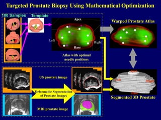 Atlas with optimal
needle positions
Apex
Base
Left
Right
6
7
4
3
1
2
5
Apex
Base
Left Right
Targeted Prostate Biopsy Using Mathematical Optimization
100 Samples Template
…
Segmented 3D Prostate
Warped Prostate Atlas
US prostate image
MRI prostate image
Deformable Segmentation
of Prostate Images
 