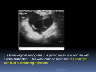 Sonographic Evaluation of Pelvic Masses | PDF